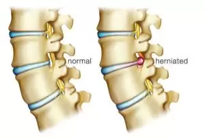 Herniated Disc